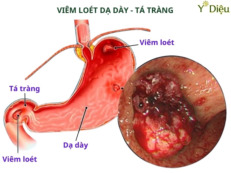Bị xuất huyết tiêu hóa là một dấu hiệu ung thư dạ dày